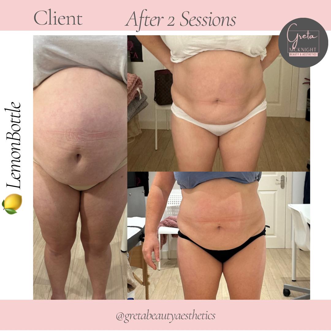 Lemon Bottle Fat Dissolving Injection Training - Cork