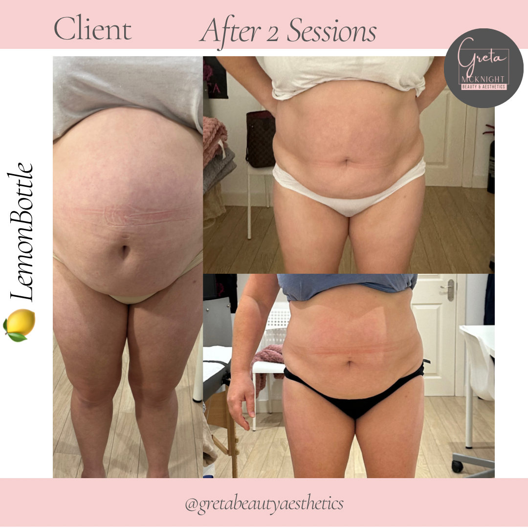 Lemon Bottle Fat Dissolving Injection Training - Dublin