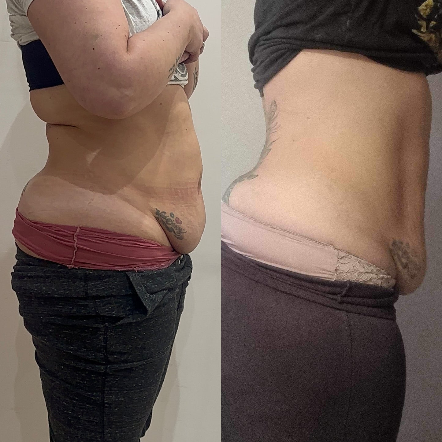 Lemon Bottle Fat Dissolving Injection Training - Central Scotland