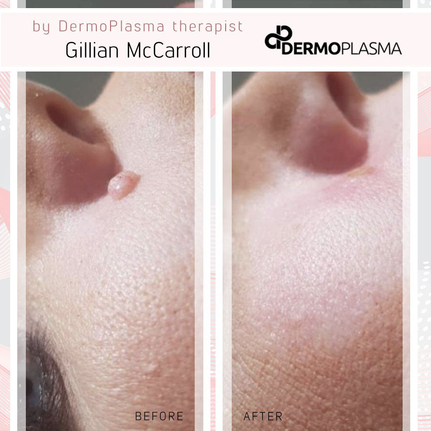 Plasma Fibroblast (LW) Training NI